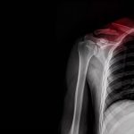 افزایش بستری کودکان به‌دلیل شکستگی ترقوه