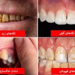 رنگ دندان از دیدگاه علم چه چیزهایی درباره سلامت شما می‌گوید؟